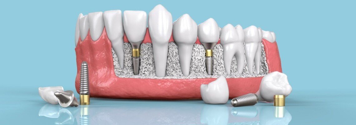 Beyond Aesthetics: Functional Benefits of Dental Implants