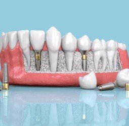 Beyond Aesthetics: Functional Benefits of Dental Implants